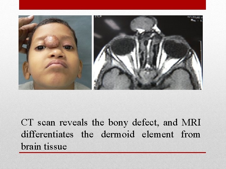 CT scan reveals the bony defect, and MRI differentiates the dermoid element from brain