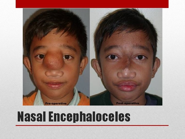 Nasal Encephaloceles 
