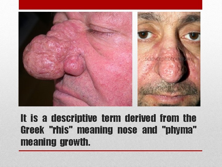 It is a descriptive term derived from the Greek "rhis" meaning nose and "phyma"