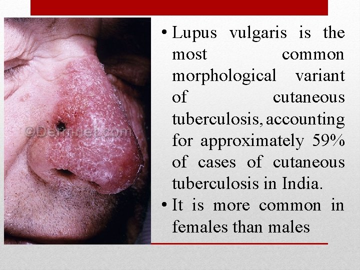  • Lupus vulgaris is the most common morphological variant of cutaneous tuberculosis, accounting