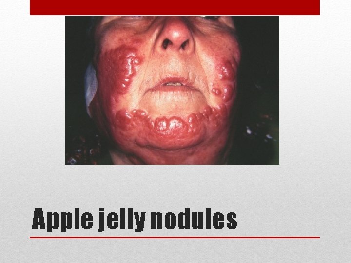 Apple jelly nodules 