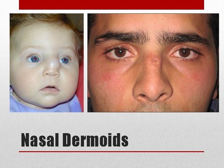 Nasal Dermoids 