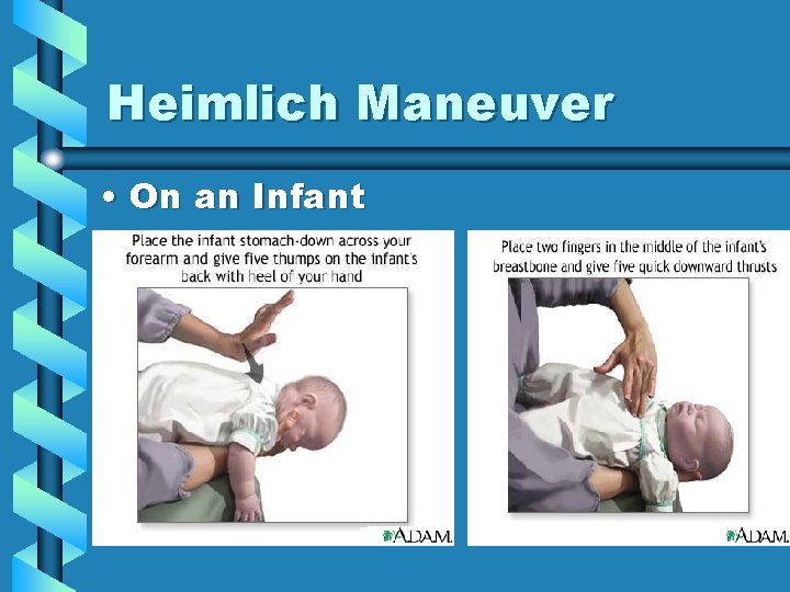 Heimlich Maneuver • On an Infant 