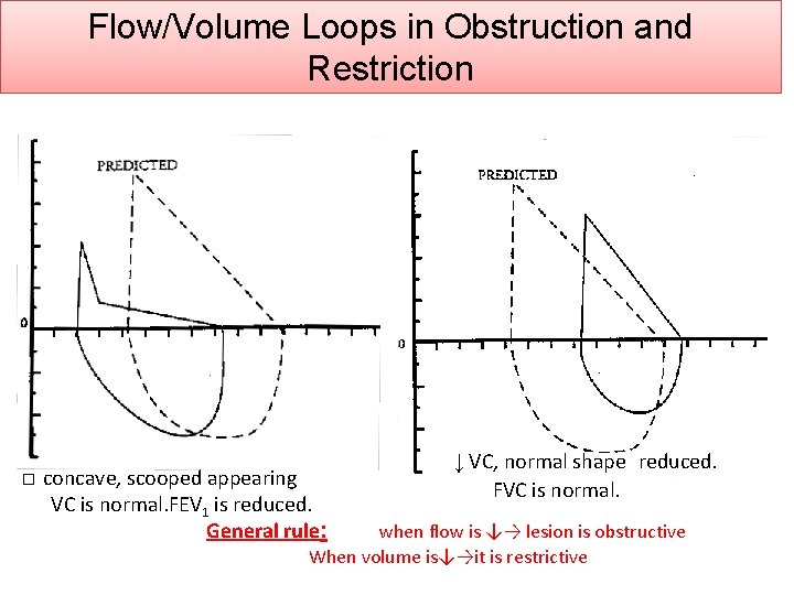 Flow/Volume Loops in Obstruction and Restriction � concave, scooped appearing VC is normal. FEV