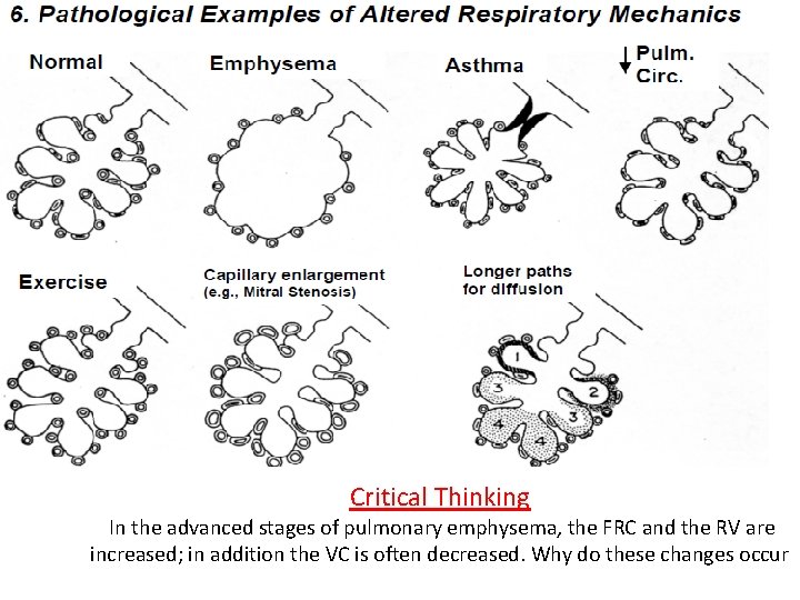 Critical Thinking In the advanced stages of pulmonary emphysema, the FRC and the RV Critical Thinking In the advanced stages of pulmonary emphysema, the FRC and the RV