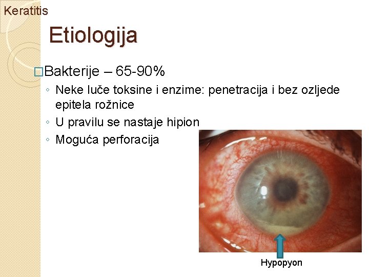 Keratitis Etiologija �Bakterije – 65 -90% ◦ Neke luče toksine i enzime: penetracija i