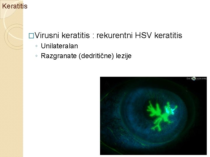 Keratitis �Virusni keratitis : rekurentni HSV keratitis ◦ Unilateralan ◦ Razgranate (dedritične) lezije 