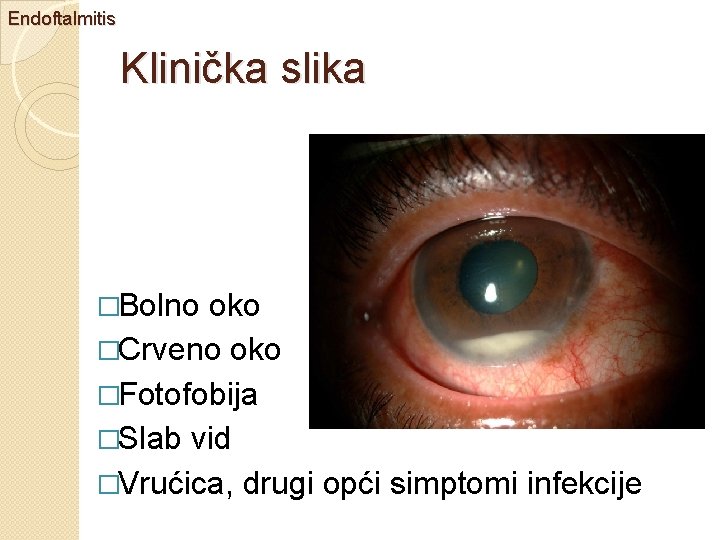 Endoftalmitis Klinička slika �Bolno oko �Crveno oko �Fotofobija �Slab vid �Vrućica, drugi opći simptomi