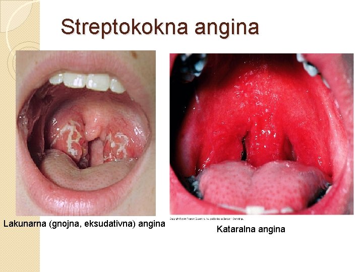 Streptokokna angina Lakunarna (gnojna, eksudativna) angina Kataralna angina 