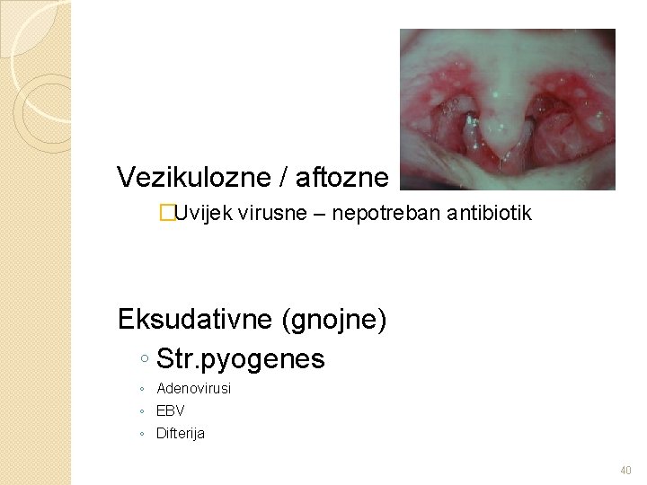 Vezikulozne / aftozne �Uvijek virusne – nepotreban antibiotik Eksudativne (gnojne) ◦ Str. pyogenes ◦