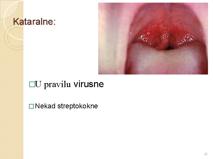 Kataralne: �U pravilu virusne � Nekad streptokokne 41 