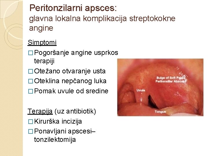Peritonzilarni apsces: glavna lokalna komplikacija streptokokne angine Simptomi � Pogoršanje angine usprkos terapiji �