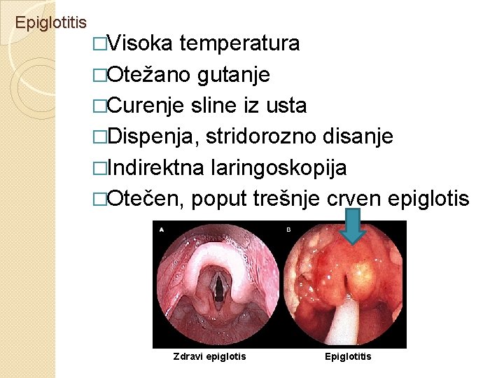 Epiglotitis �Visoka temperatura �Otežano gutanje �Curenje sline iz usta �Dispenja, stridorozno disanje �Indirektna laringoskopija