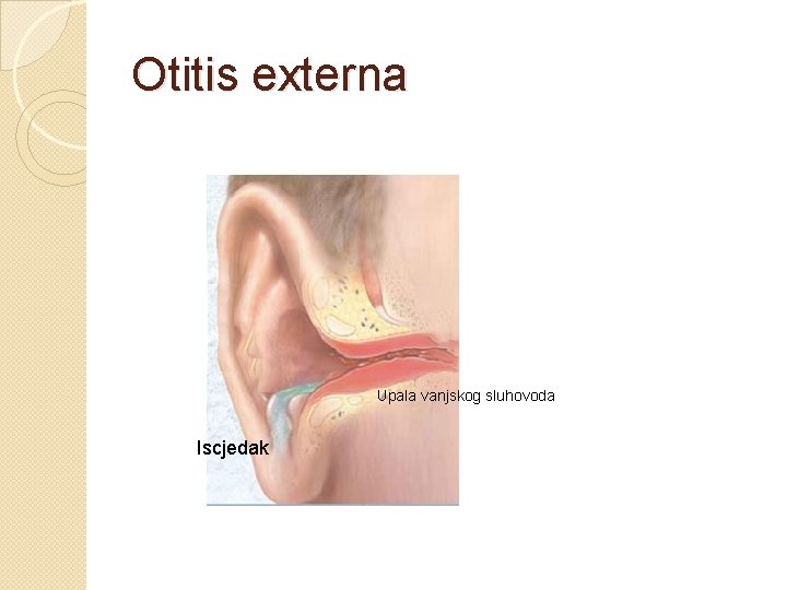 Otitis externa Upala vanjskog sluhovoda Iscjedak 