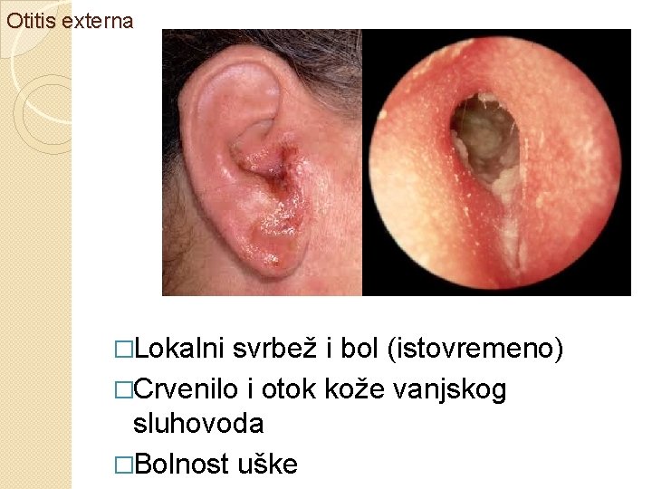 Otitis externa �Lokalni svrbež i bol (istovremeno) �Crvenilo i otok kože vanjskog sluhovoda �Bolnost