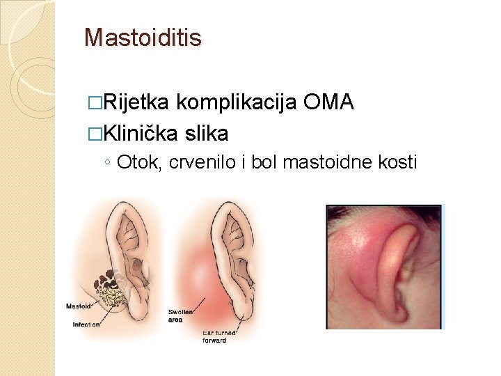 Mastoiditis �Rijetka komplikacija OMA �Klinička slika ◦ Otok, crvenilo i bol mastoidne kosti 