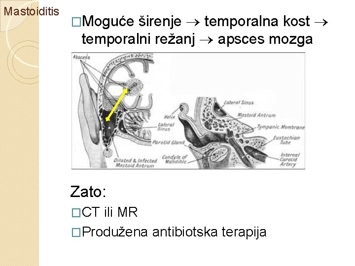 Mastoiditis širenje temporalna kost temporalni režanj apsces mozga �Moguće Zato: �CT ili MR �Produžena