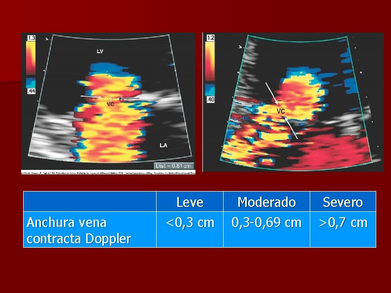 Anchura vena contracta Doppler Leve <0, 3 cm Moderado 0, 3 -0, 69 cm