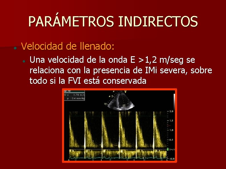 PARÁMETROS INDIRECTOS Velocidad de llenado: Una velocidad de la onda E >1, 2 m/seg