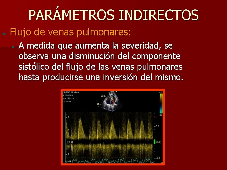 PARÁMETROS INDIRECTOS Flujo de venas pulmonares: A medida que aumenta la severidad, se observa