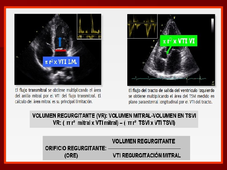 INSUFICIENCIA MITRAL PROLAPSO MITRAL Sergio Vsquez Ferreccio Crsitina