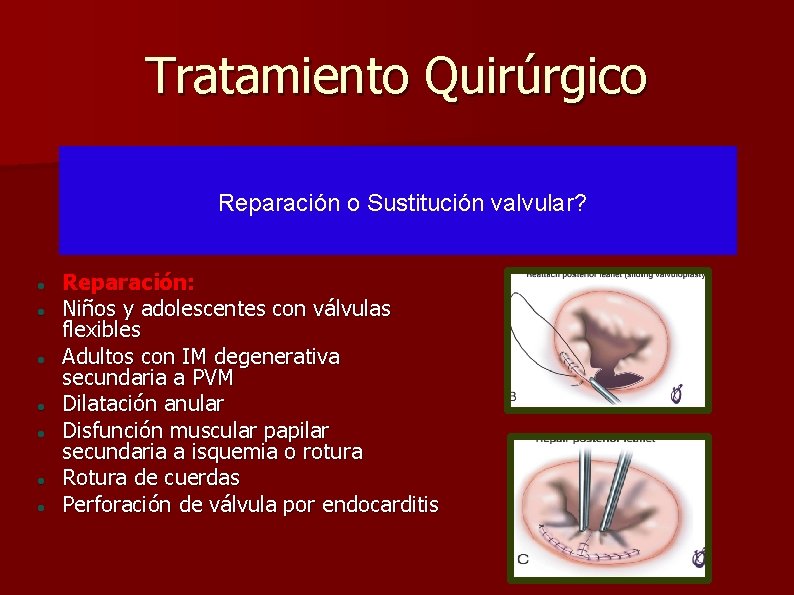 Tratamiento Quirúrgico Reparación o Sustitución valvular? Reparación: Niños y adolescentes con válvulas flexibles Adultos