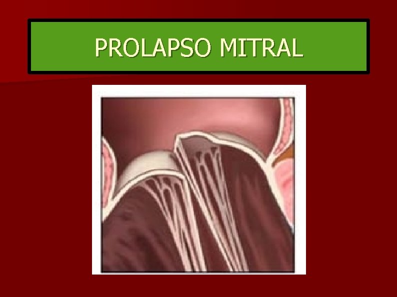 PROLAPSO MITRAL 