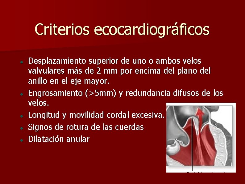 Criterios ecocardiográficos Desplazamiento superior de uno o ambos velos valvulares más de 2 mm