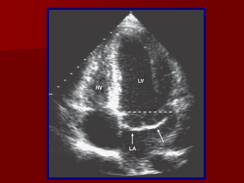 INSUFICIENCIA MITRAL PROLAPSO MITRAL Sergio Vsquez Ferreccio Crsitina