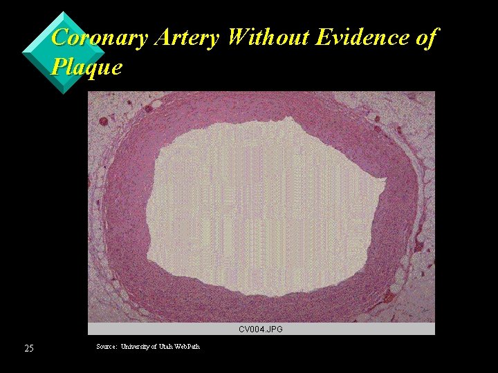 Coronary Artery Without Evidence of Plaque 25 Source: University of Utah Web. Path 