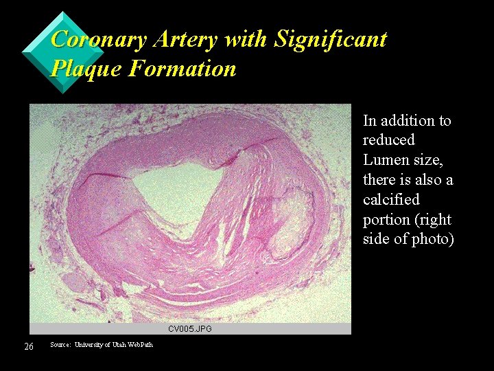Coronary Artery with Significant Plaque Formation In addition to reduced Lumen size, there is