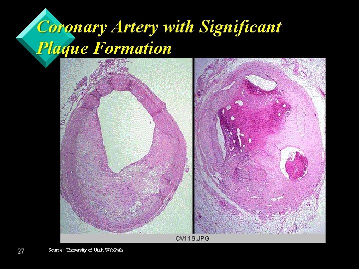 Coronary Artery with Significant Plaque Formation 27 Source: University of Utah Web. Path 
