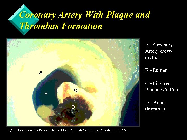 Coronary Artery With Plaque and Thrombus Formation A - Coronary Artery crosssection B -