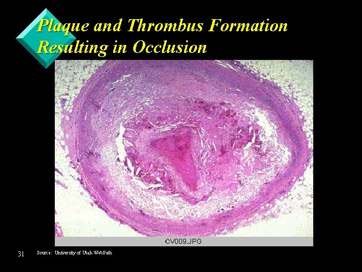 Plaque and Thrombus Formation Resulting in Occlusion 31 Source: University of Utah Web. Path