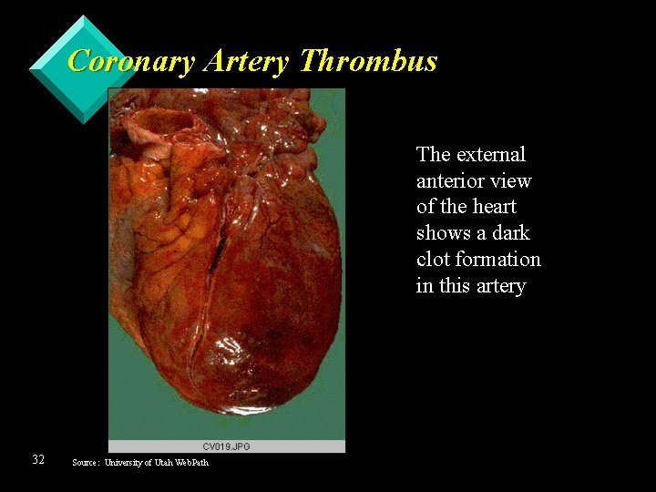 Coronary Artery Thrombus The external anterior view of the heart shows a dark clot