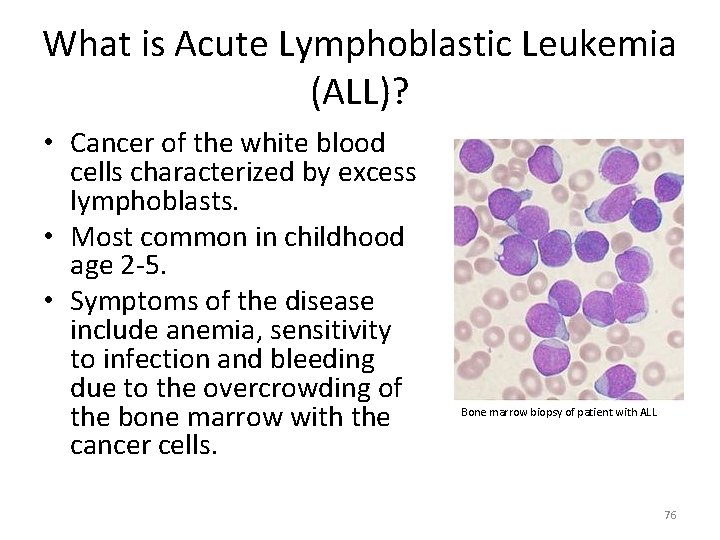 What is Acute Lymphoblastic Leukemia (ALL)? • Cancer of the white blood cells characterized