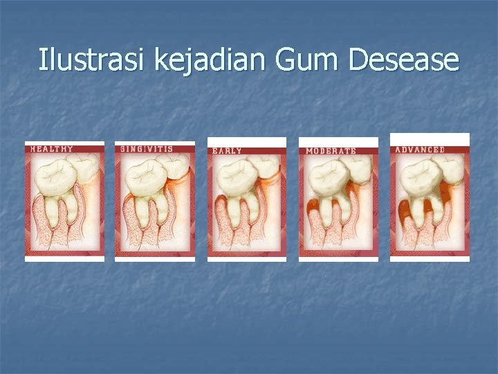 Ilustrasi kejadian Gum Desease 