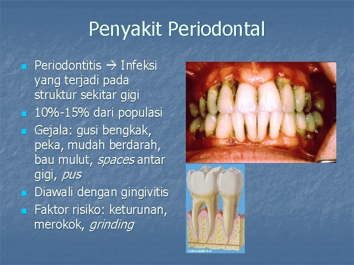 Penyakit Periodontal n n n Periodontitis Infeksi yang terjadi pada struktur sekitar gigi 10%-15%