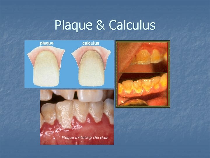 Plaque & Calculus 