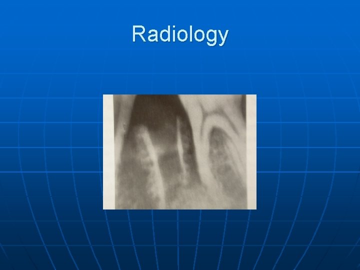 Acute Alveolar Osteitis Dr Ashraf Abu Karaky Assistant