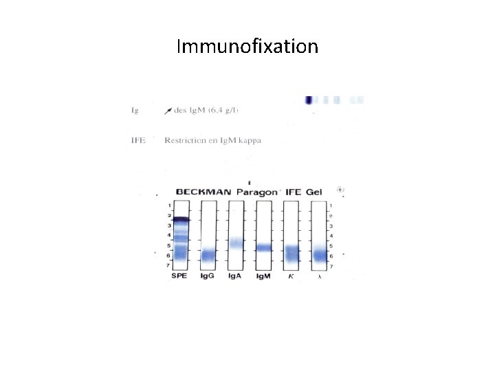 Immunofixation 