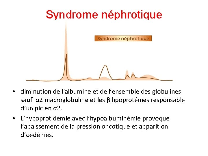 Syndrome néphrotique • diminution de l'albumine et de l’ensemble des globulines sauf α 2