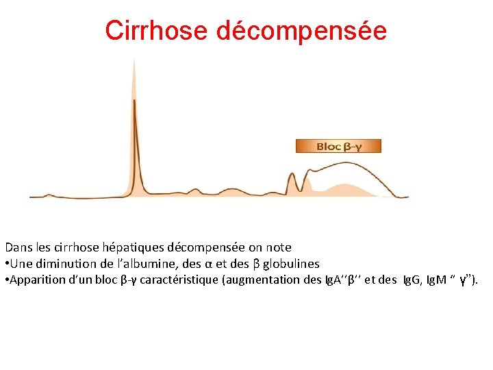 Cirrhose décompensée Dans les cirrhose hépatiques décompensée on note • Une diminution de l’albumine,