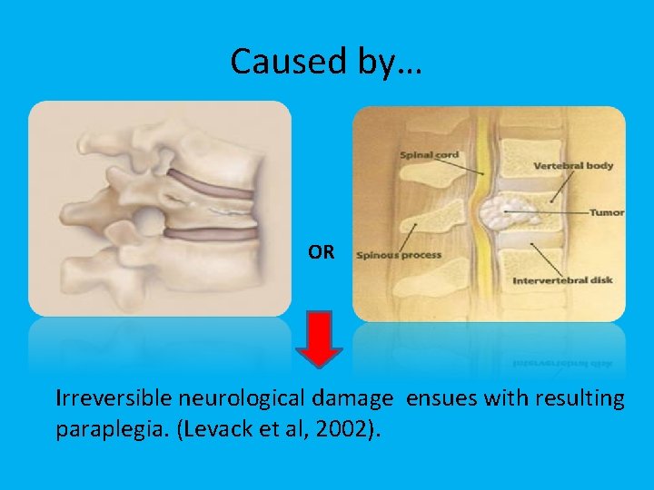 Caused by… OR Irreversible neurological damage ensues with resulting paraplegia. (Levack et al, 2002).