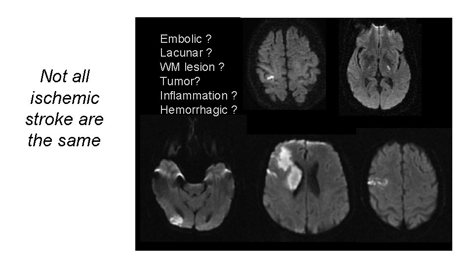 Not all ischemic stroke are the same Embolic ? Lacunar ? WM lesion ?