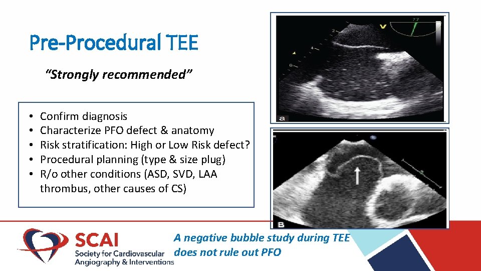 Pre-Procedural TEE “Strongly recommended” • • • Confirm diagnosis Characterize PFO defect & anatomy