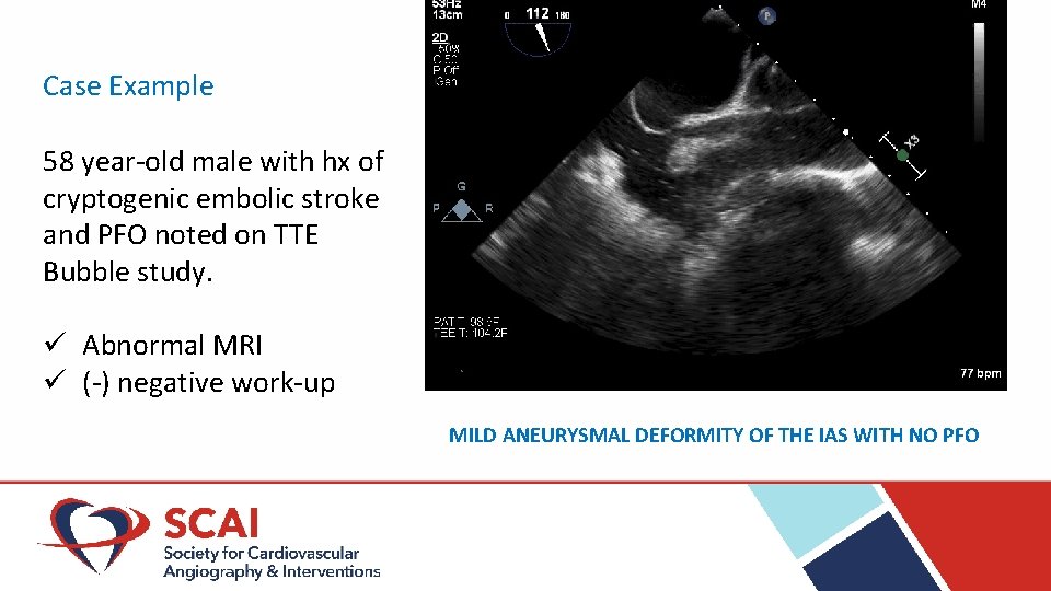 Case Example 58 year-old male with hx of cryptogenic embolic stroke and PFO noted