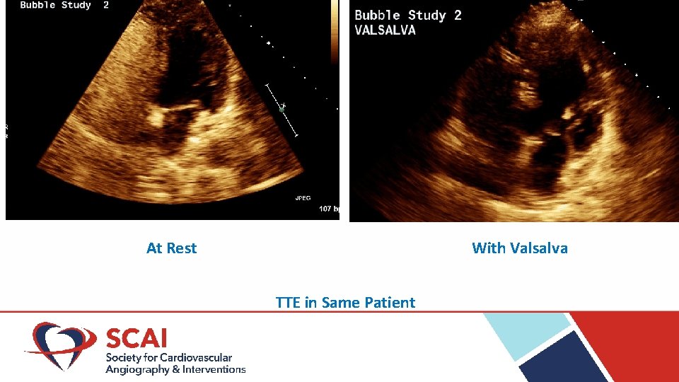 At Rest With Valsalva TTE in Same Patient 