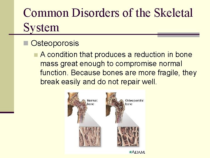 Common Disorders of the Skeletal System n Osteoporosis n A condition that produces a