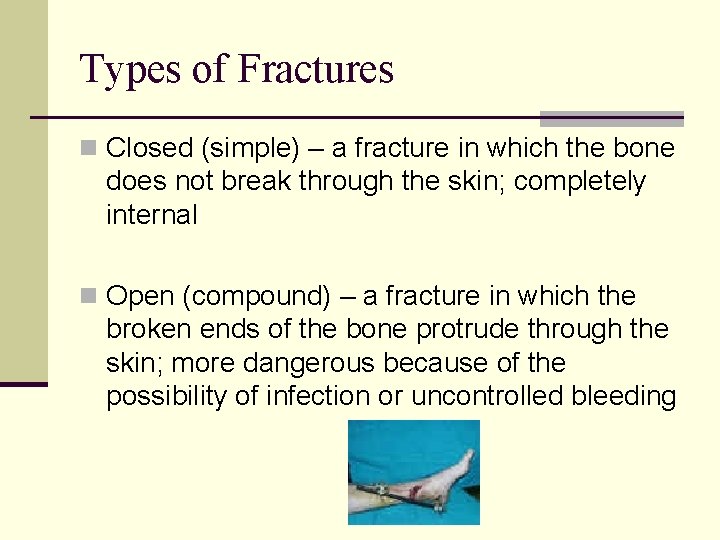 Types of Fractures n Closed (simple) – a fracture in which the bone does
